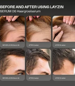 LAYZIN Haargroei Set minder haaruitval en meer haargroei
